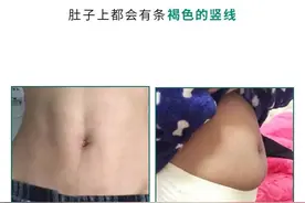 为什么很多女生肚子上，有条褐色的竖线？看完这个你就知道了图片