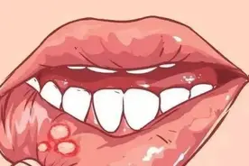 口腔溃疡可以吃什么缓解？图片