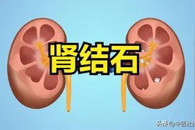 肾结石疼痛难忍，中医送你1个方子和3个动作，帮助结石快速排出图片
