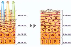 LED-IB 光动力治疗仪结合光敏剂ALA治疗鲜红斑痣图片