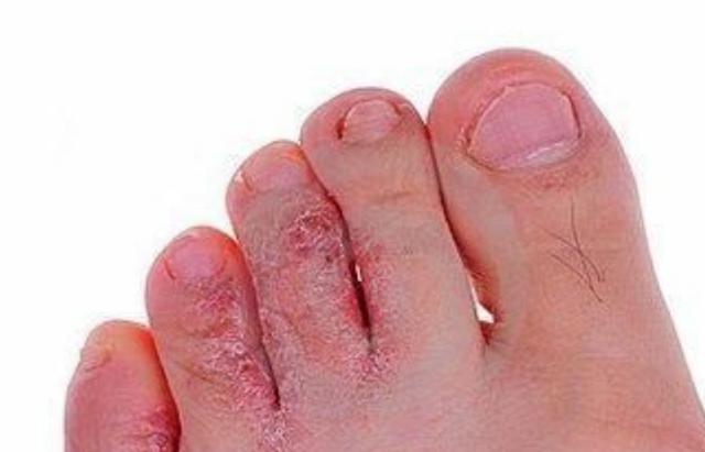 角化过度型脚癣用药