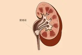 肾脏受损，有可能逆转吗？做好一件事，或有希望逆转，早了解早好图片