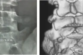 隐性脊柱裂什么情况下需要手术治疗？图片