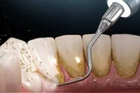 牙结石不要洗牙也能去除？过来人的方法果真神奇！赶紧收藏！图片