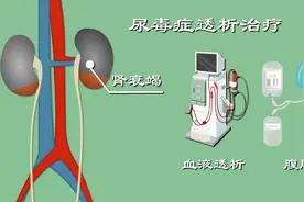 尿毒症只能透析保命？昏迷？心衰？透析有啥危险？走近透析真相图片