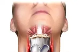 甲状腺癌须知：得了乳头状癌后，手术是怎么治疗的？图片
