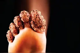 有痛风疾病要怎么治疗才会好一点呢？图片