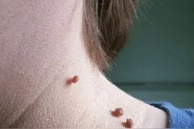 脖子和腋下的“小肉粒”是什么？可以用手直接揪掉吗？涨知识了图片