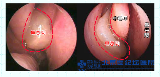 走进鼻子系列——治疗鼻炎之后策 手术篇