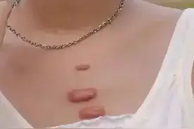 疤痕疙瘩涂药能治好吗？疤痕疙瘩只涂抹药物能好吗？图片