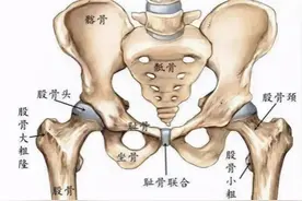 股骨头坏死最经典的五大症状，早发现早治疗图片