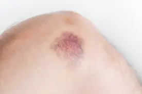 血小板计数高的人，通常有这几个表现，快来自查一下！图片