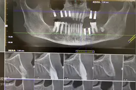 种植牙会后悔么？五个缺点必须了解图片