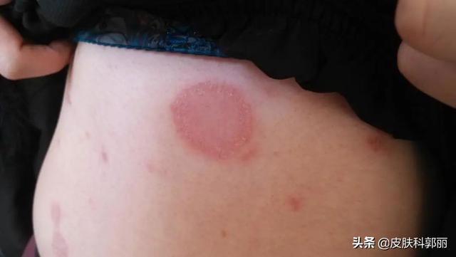 什么皮肤病和鸡皮肤很像