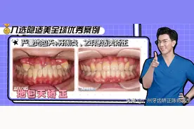 严重地包天+牙周炎，2年隐适美改善凹面型图片