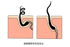 洗澡时“下面”的毛毛掉落很多，这是正常吗？其实原因有4个图片
