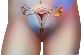 32岁女子下腹痛却找不出原因？医生：慢性盆腔炎经常被忽略图片