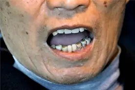 俗语“缺牙一颗，掉牙三颗”，有道理吗？人过60，多少颗牙达标？图片