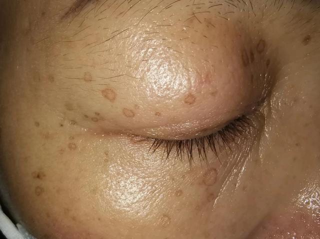 汗孔角化症痒用什么药