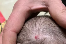 新生儿血管瘤图片