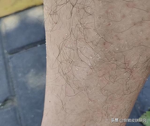 腿干燥鱼鳞一样怎么回事