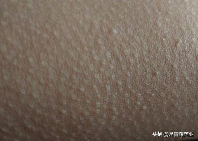 胳膊突然摸起来有鸡皮肤