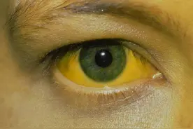 这4个信号，可能是肝在求救，医生告诉你不要大意图片