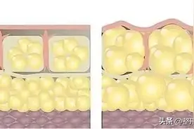 深圳军科整形医院：脂肪移植填充隆胸有哪些风险？图片