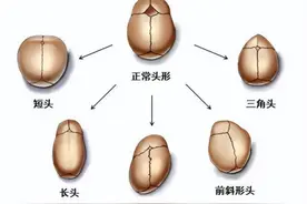 这类异常头型都是“颅缝早闭”惹的祸！赶紧来看看吧！图片