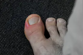 脚趾甲老往肉里钻，一碰还疼？教你小方法，预防甲沟炎告别疼痛图片