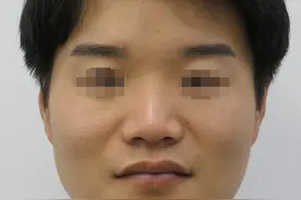 30岁南京小伙做全鼻+下巴改造，短短6个月“变脸比翻书还快”？图片
