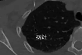 省内首次！吉大二院开展肺部肿瘤微创微波消融术图片