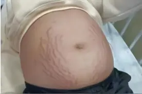 初一女童肚子隆起、腹痛、长妊娠纹，医生：没怀孕，但情况更致命图片