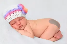 5种宝宝常见胎记大盘点，哪些可能癌变？哪些不用管，60秒辨别图片