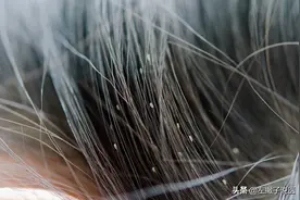 30年前人们头上常见的虱子，为何如今看不到了？真相来了图片