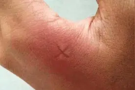 被蚊子咬了后，蚊子包越大说明毒性越强？如何更高效地驱蚊子？图片