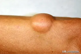 一个散结节的方子，横扫息肉、肌瘤、脂肪瘤，化一身包块图片