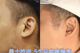 男生做拉皮会不会留疤？图片