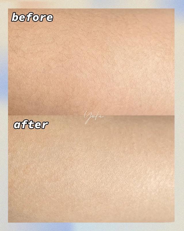 冰点脱毛以后可以擦身体乳吗