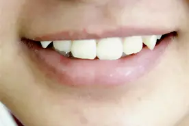 60岁后，剩多少颗牙齿算正常？掉牙和寿命有关系，是真是假？图片