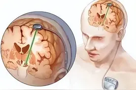 神奇！植入“脑起搏器”，帕金森病患者可开启新人生图片