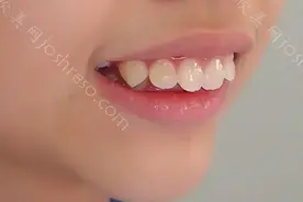 戴牙套1-12个月的变化，来看看戴牙套的蜕变图片
