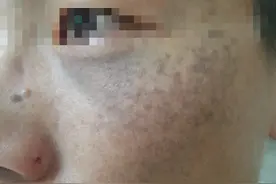 你知道孩子的胎记是哪种吗？这5种常见的胎记快来对照一下吧图片