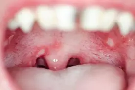 口腔溃疡是什么样子图片