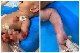 汉中新生儿患上罕见遗传性皮肤病 西安医生精心救治“蝴蝶宝贝”获新生图片