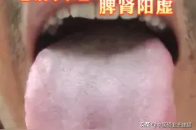 今日分享一舌诊案例：心肝火旺！脾肾阳虚！脾胃虚弱！肝血不足！图片