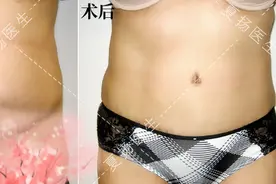 腹壁成形术可以祛妊娠纹吗图片