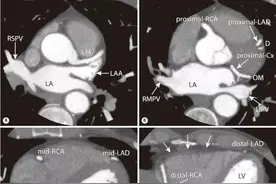 冠状动脉CT：相关概念、解剖图片