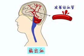 什么是脑溢血！脑溢血来临前，身体有哪些异常？望知晓图片