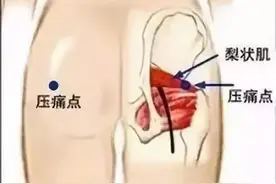 什么是梨状肌症候群？梨状肌症候群常见的治疗方案图片